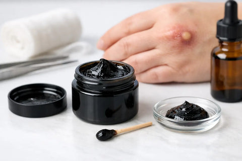What Is Ichthammol Salve Used For?